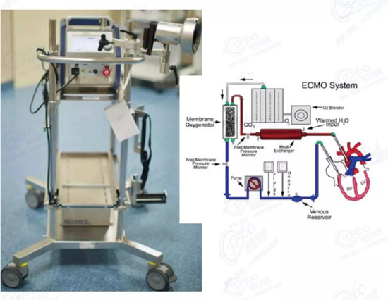 體外膜肺氧合(ECMO)設(shè)備 體外膜肺氧合(ECMO)設(shè)備